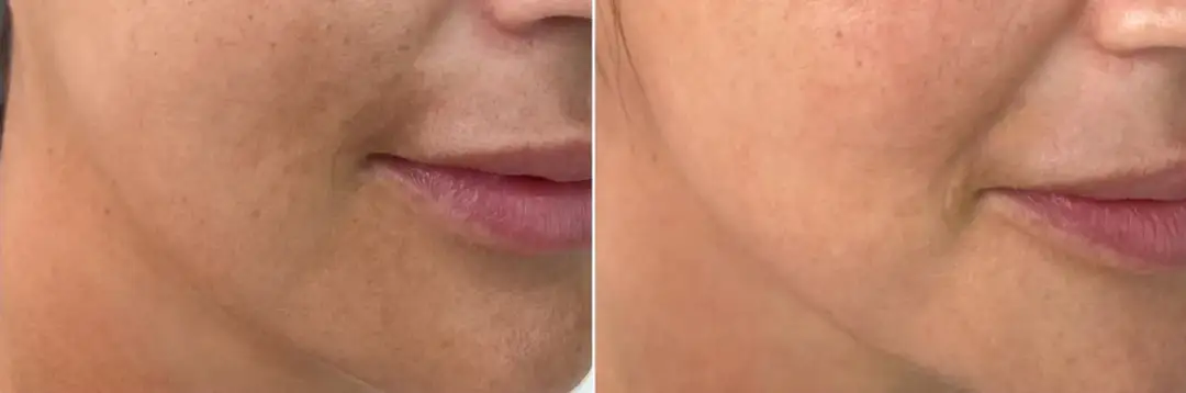 Ile zabiegów laserem frakcyjnym potrzebujesz, aby uniknąć rozczarowania?