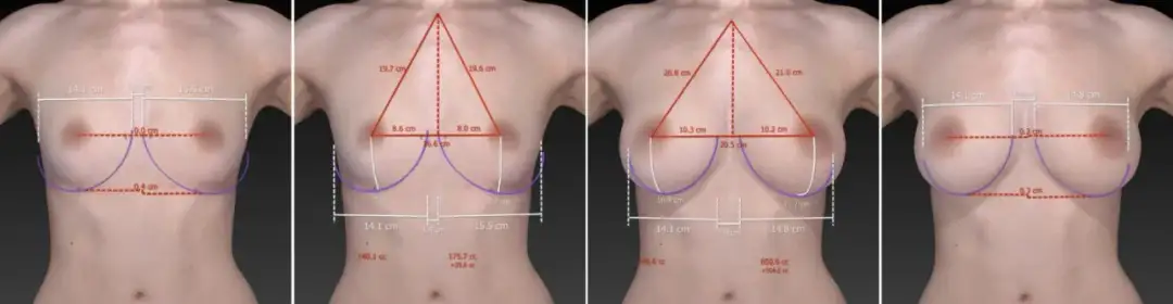 Gdzie najlepiej zrobić operację powiększenia biustu? Ranking klinik