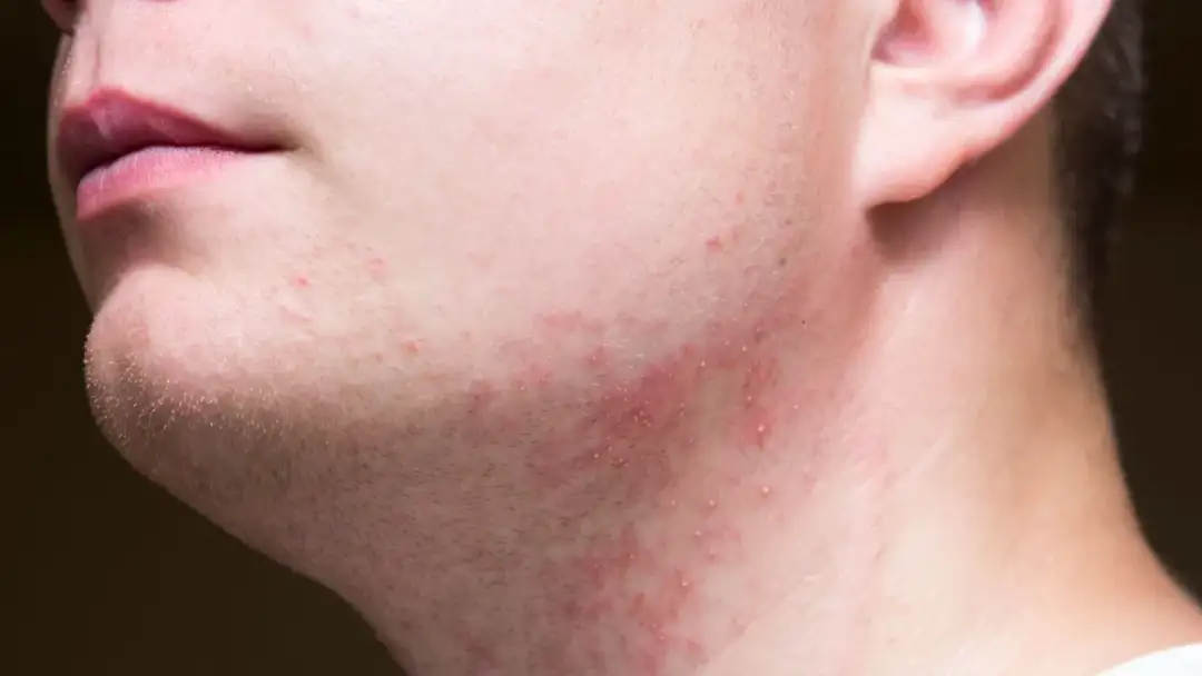 Czym smarować podrażnienia po goleniu, aby szybko złagodzić ból?