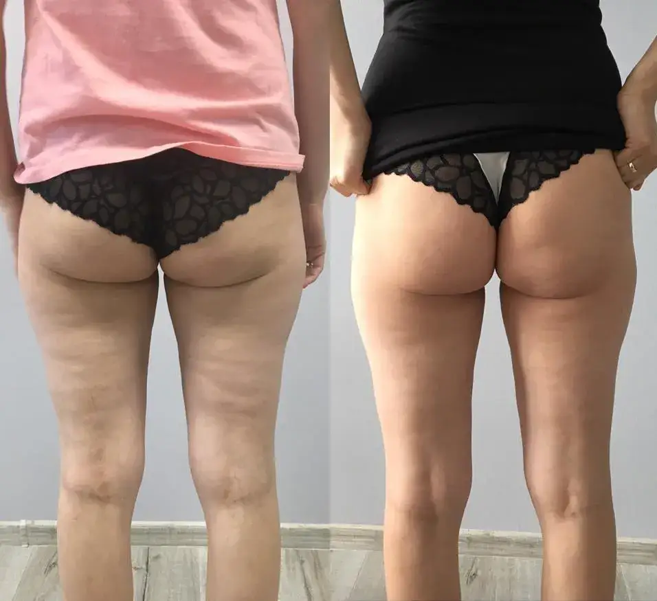 Indiba - Opinie na temat zabiegu i efektów