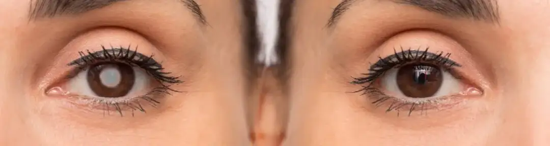 Jak szybko postępuje zaćma? Poznaj niebezpieczeństwa i objawy