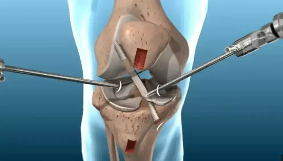 Ile trwa rehabilitacja po artroskopii kolana? Czas i kluczowe informacje