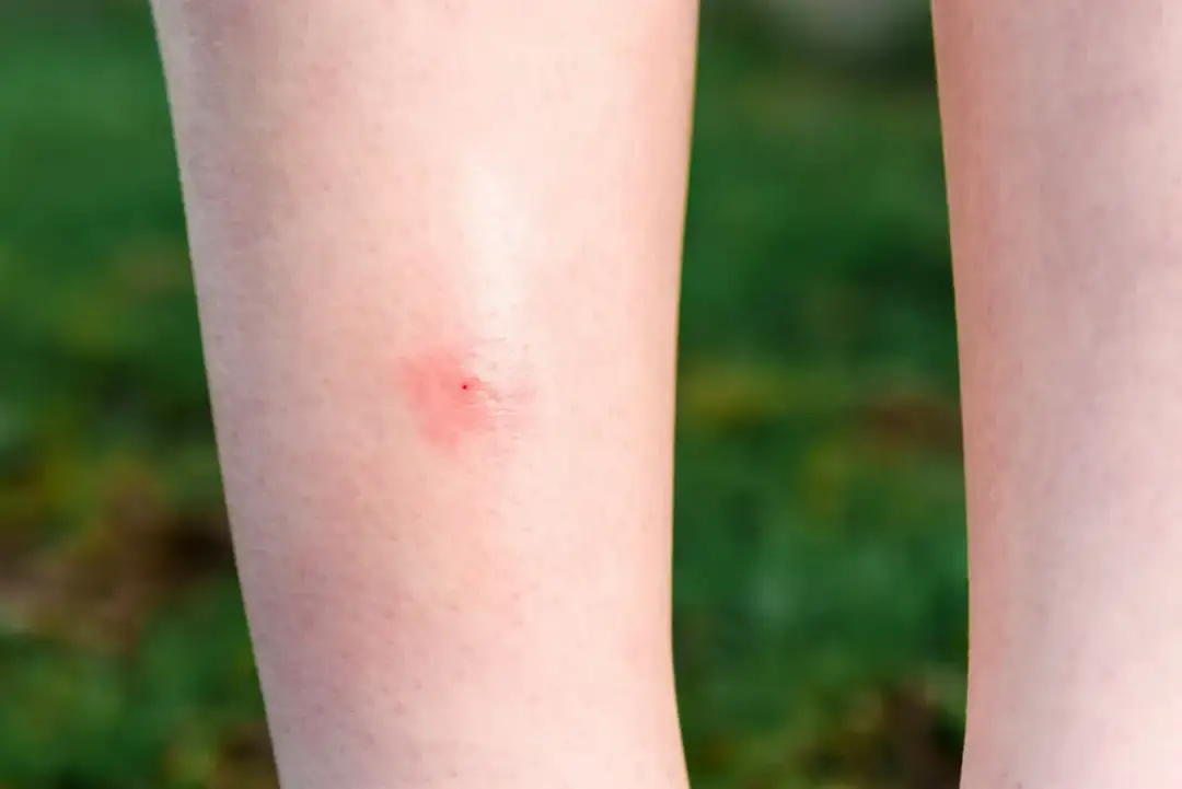 Nocne ataki owadów: Czy meszki gryzą w nocy? Prawda czy mit?