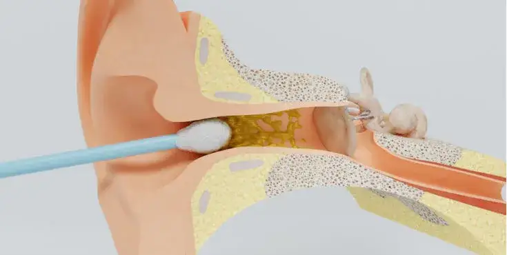 Najczęstsze objawy zapalenia ucha: jak rozpoznać groźną infekcję?