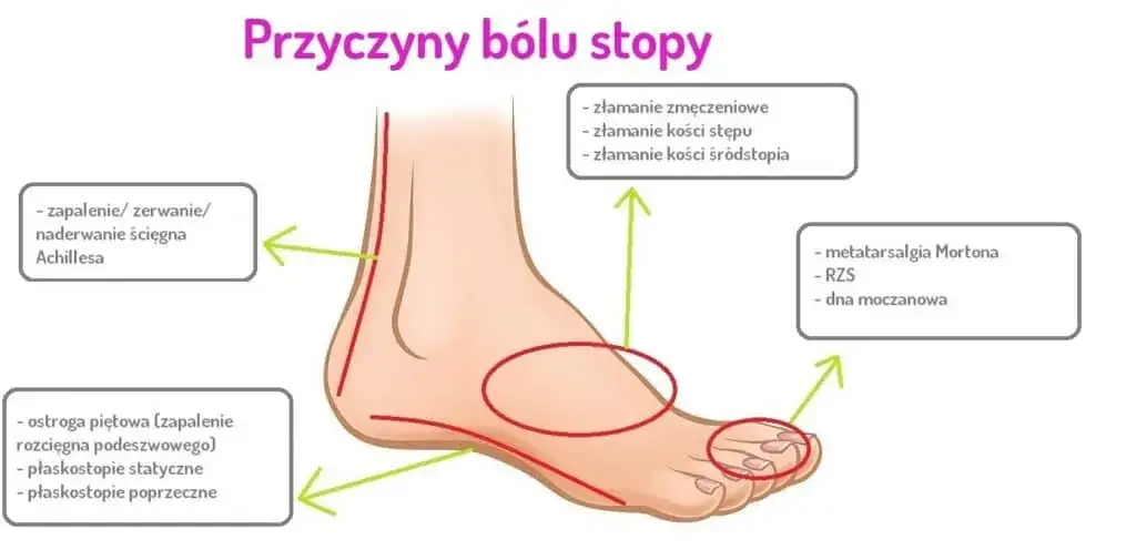 Ból śródstopia przyczyna: poznaj najczęstsze źródła dyskomfortu