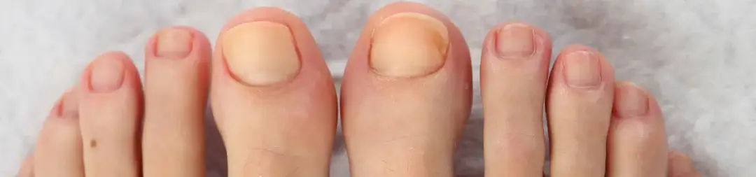 Grzybica stóp i paznokci: skuteczne metody, które przynoszą trwały efekt