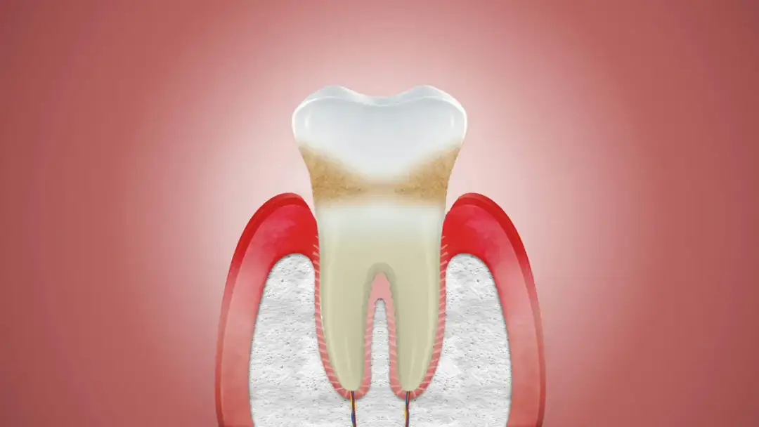 Uszkodzone dziąsła nie odrastają? Poznaj skuteczne metody leczenia