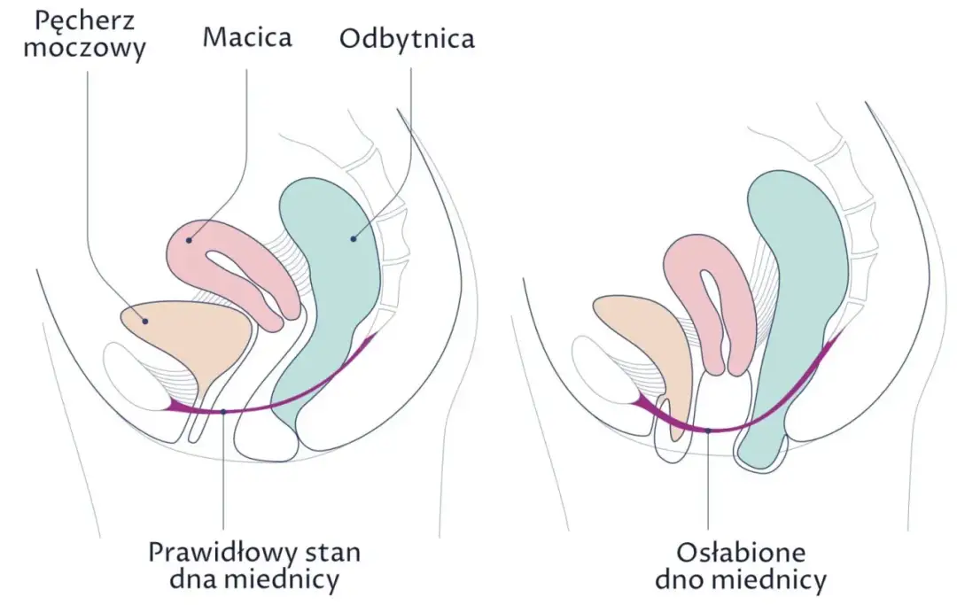 Jakie ćwiczenia na odbyt pomogą wzmocnić mięśnie i poprawić zdrowie