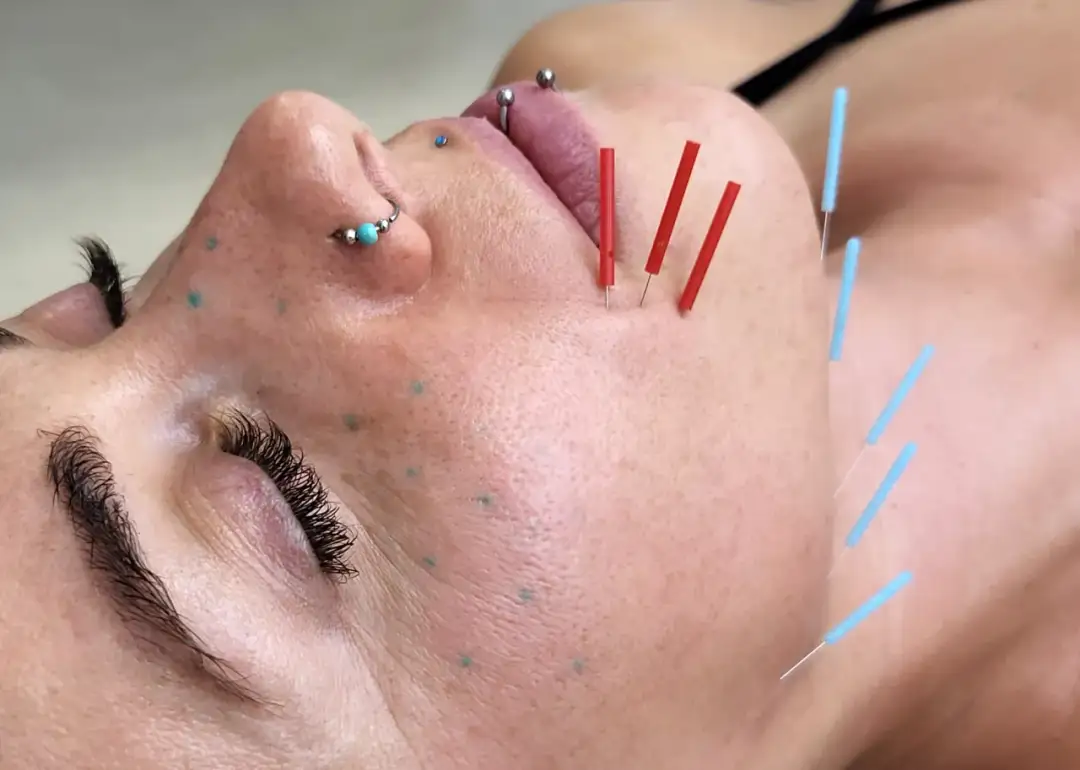 Akupunktura twarzy: Jak wybrać igły dla najlepszych efektów?