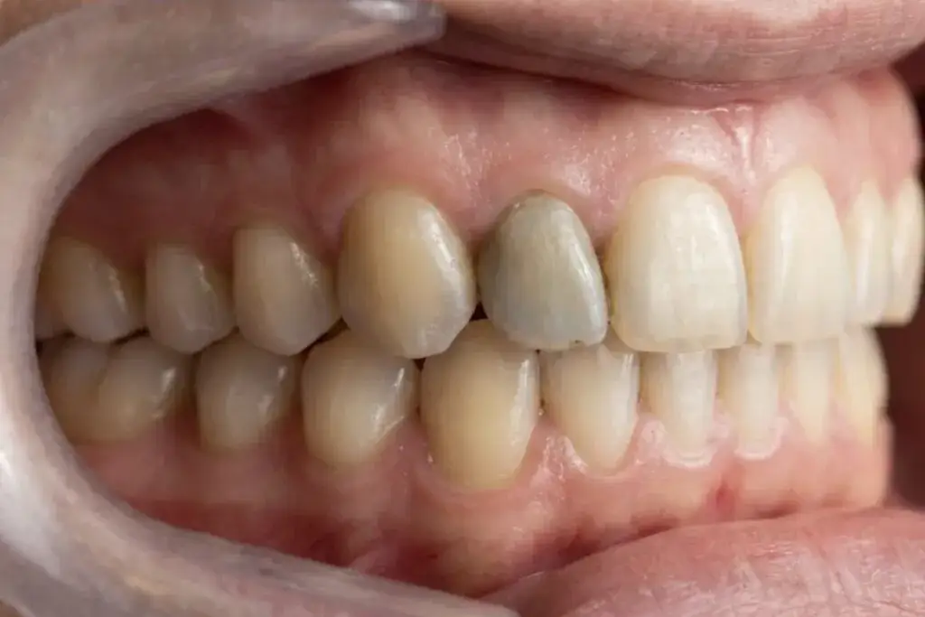 Martwy ząb: Ile lat wytrzyma? Fakty i mity o jego żywotności