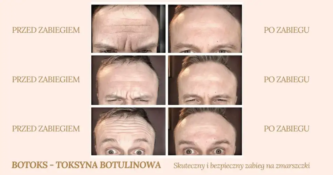 Jak długo utrzymuje się botoks na czoło? Poznaj kluczowe fakty