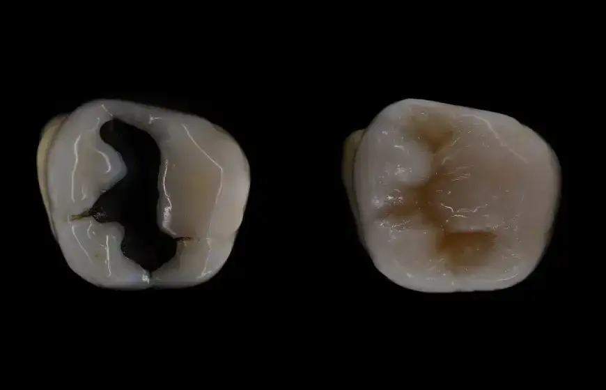 Ile kosztuje plomba światłoutwardzalna na nfz? Sprawdź, co musisz wiedzieć