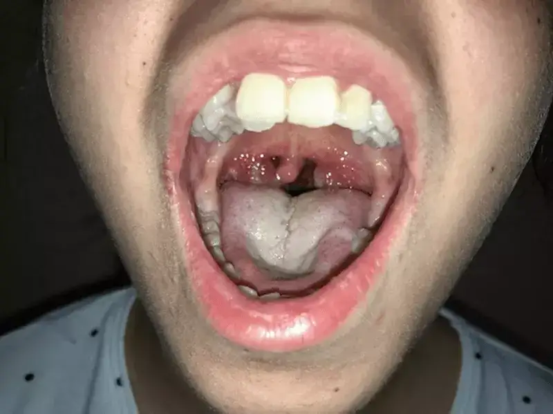 Angina u niemowlaka objawy – jak je rozpoznać i kiedy działać