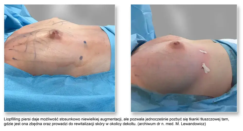 Jak długo utrzymują się efekty lipotransferu biustu? Sprawdź, co wpływa na trwałość