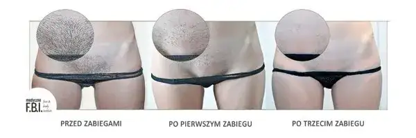 Depilacja laserowa bikini: Ile zabiegów dla gładkiej skóry na lata?