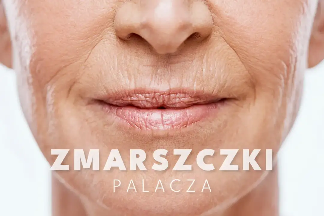 Zmarszczki na policzkach - Jak je rozpoznać i skutecznie wygładzić?