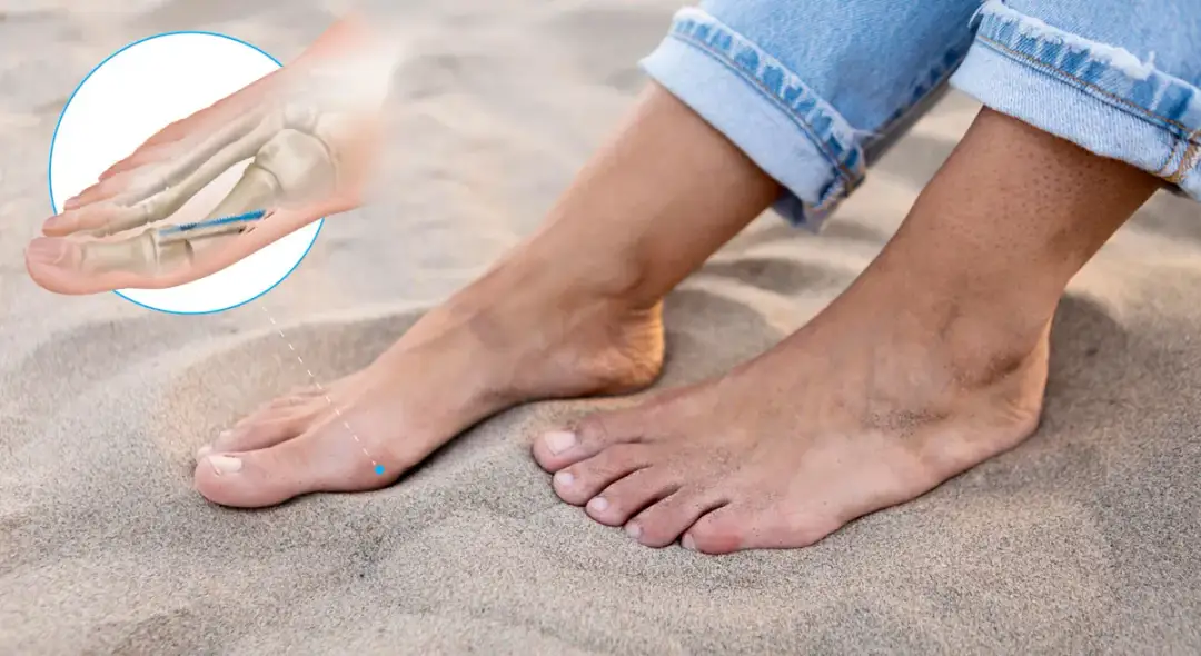 Ile trwa rehabilitacja po operacji haluksa? Poznaj czas powrotu do zdrowia