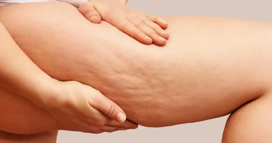 Jakie zioła na cellulit skutecznie poprawią wygląd twojej skóry