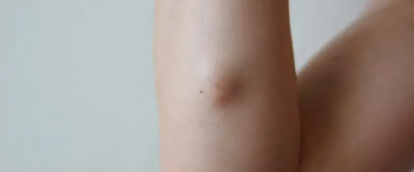 Czy torbiel może pęknąć podczas miesiączki? Objawy i zagrożenia