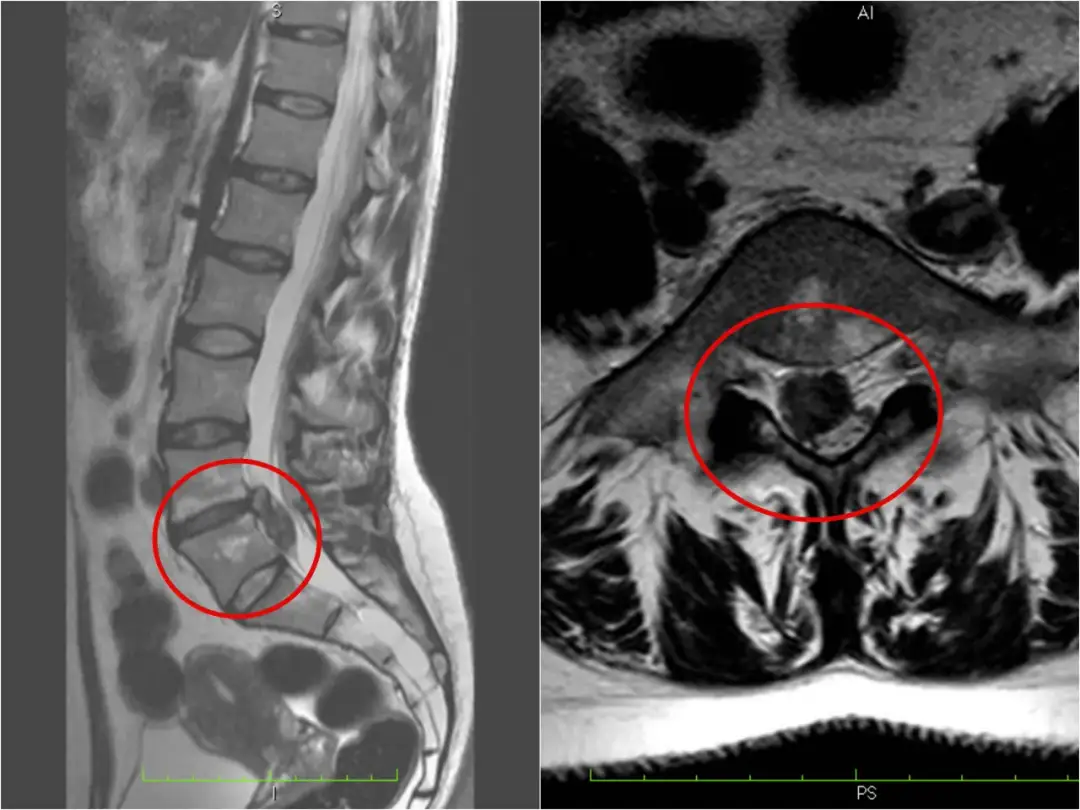 Wypuklina a przepuklina: kluczowe różnice i metody leczenia