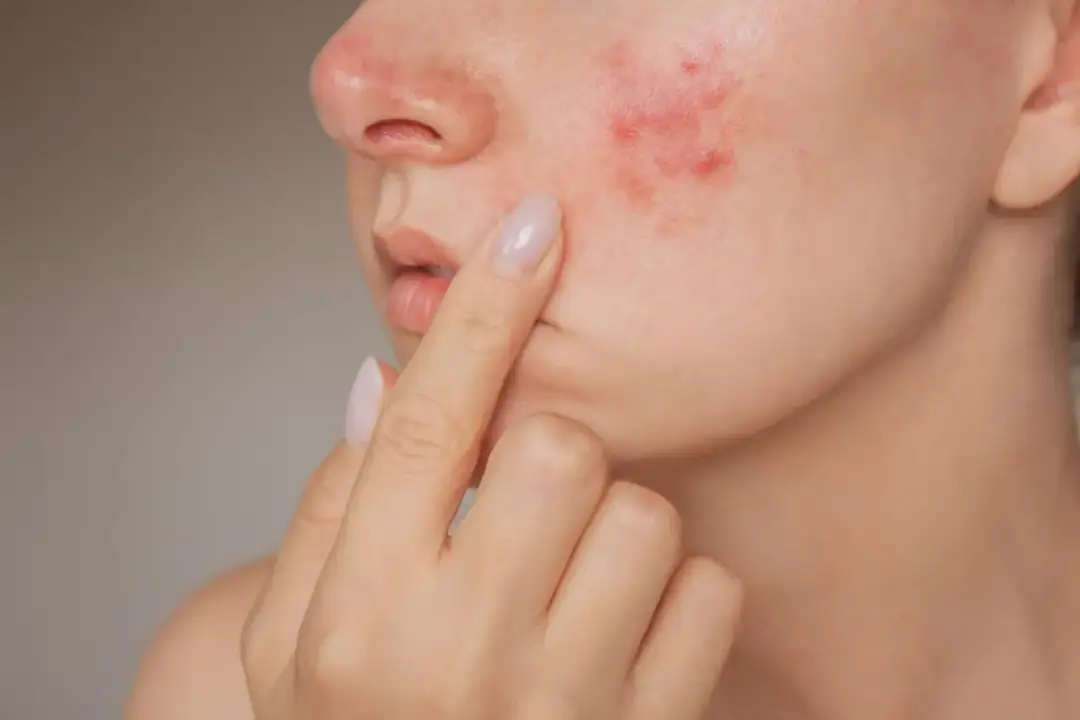 Czy plastry na pryszcze działają? Odkryj ich skuteczność i działanie