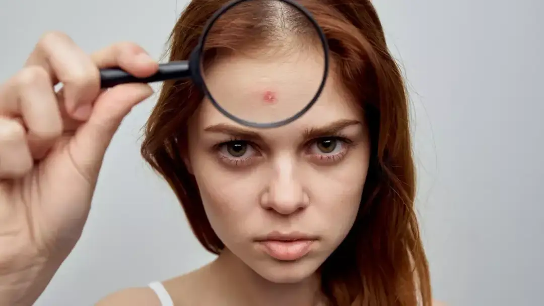 Pryszcze na czole: Skuteczne sposoby, pielęgnacja i leczenie