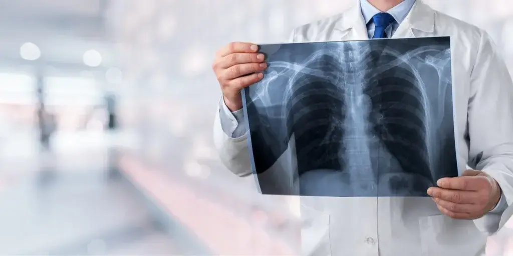 Objawy nowotworu płuc – nie bagatelizuj tych niepokojących sygnałów