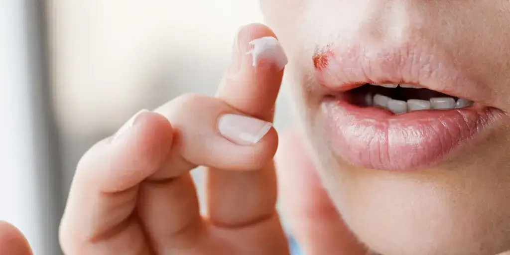 Jak leczyć ospę w jamie ustnej i złagodzić ból skutecznie