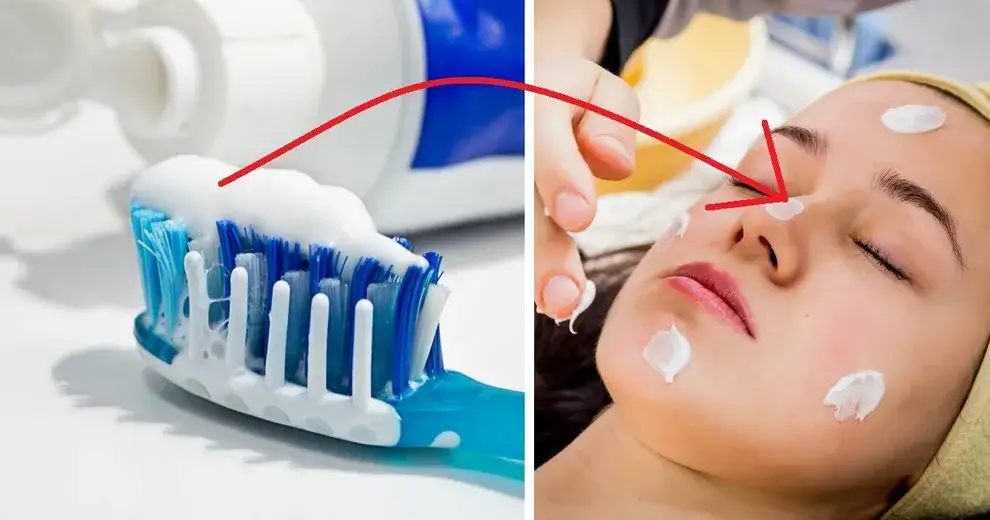 Czy pasta do zębów wysusza pryszcze? Prawda i ryzyko dla skóry