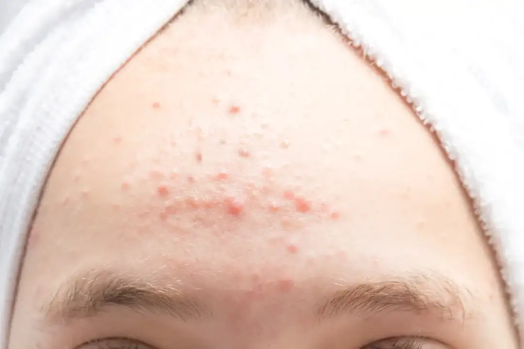 Jak pozbyć się pryszczy na czole - skuteczne sposoby na gładką skórę