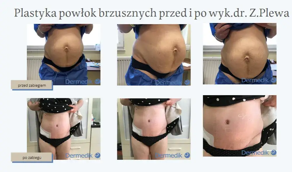 Liposukcja: Co to jest i czy to rozwiązanie dla Ciebie?