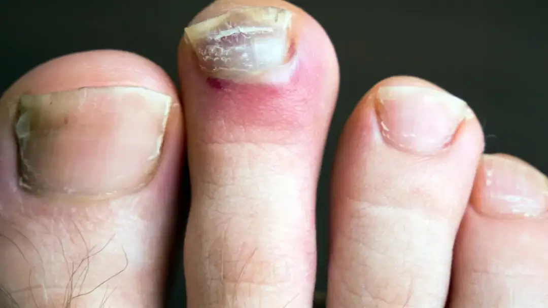 Wrastający paznokieć – jaki lekarz pomoże w skutecznym leczeniu?