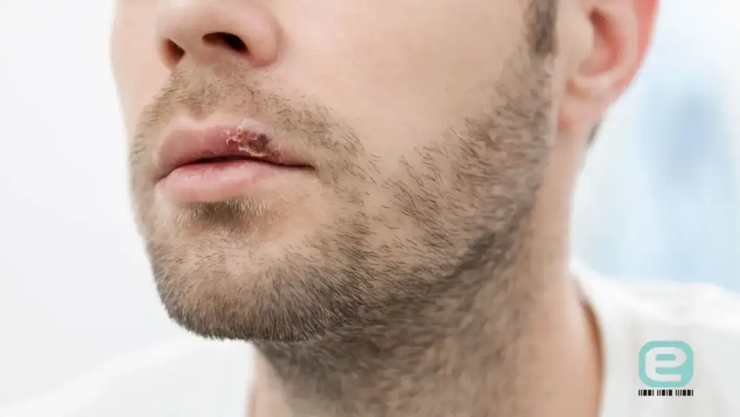 Czy z opryszczką można iść do dentysty? Ważne zasady bezpieczeństwa