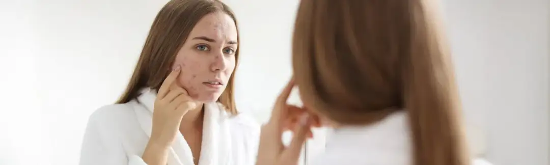 Krem do cery suchej z wypryskami – jak uniknąć podrażnień?