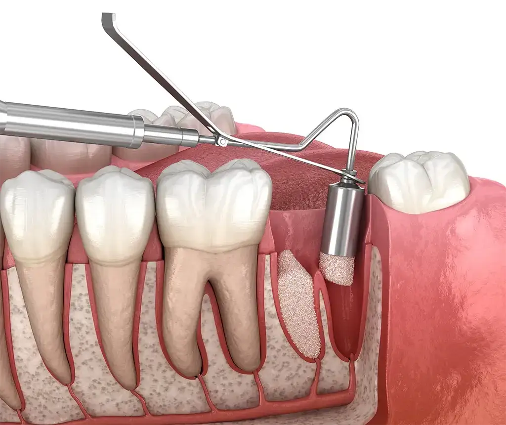 Higiena po ekstrakcji zęba: Bezpieczny przewodnik krok po kroku