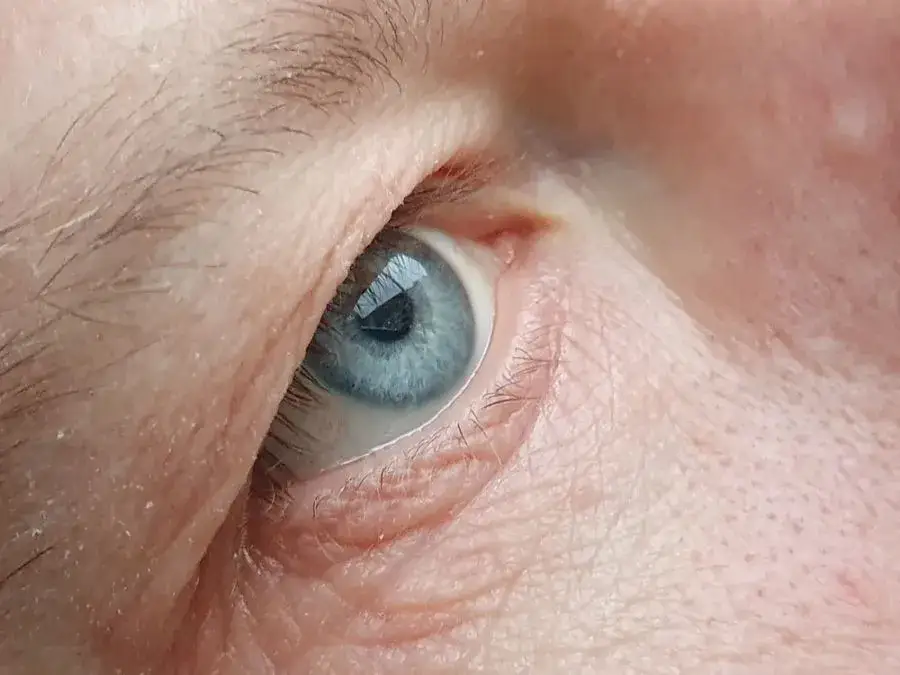 Jak wyleczyć zaćmę - skuteczne metody i prawda o operacji