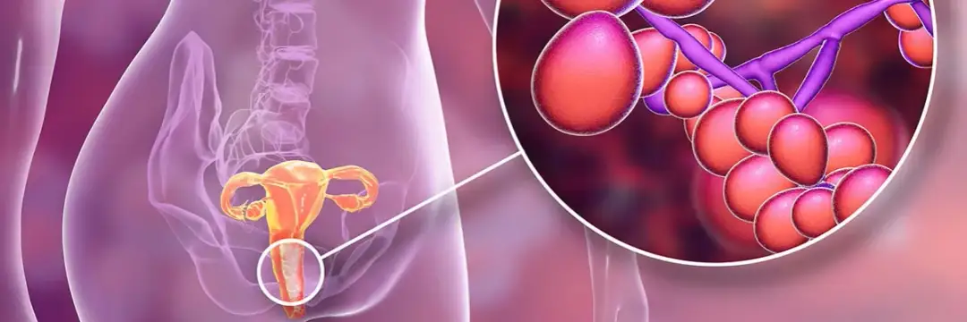 Skąd się bierze grzybica pochwy? Poznaj przyczyny i objawy