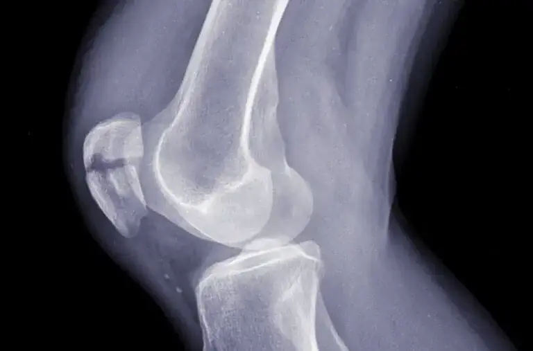 Jak wygląda skręcone kolano? Objawy, które musisz znać