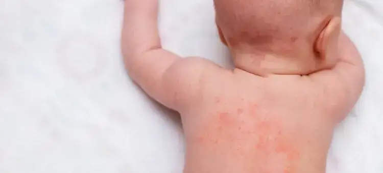 Jak kąpać dziecko z AZS, aby uniknąć podrażnień i bólu?