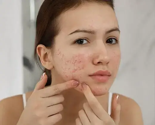 Czy warto wyciskać pryszcze? Poznaj ryzyko i bezpieczne metody pielęgnacji