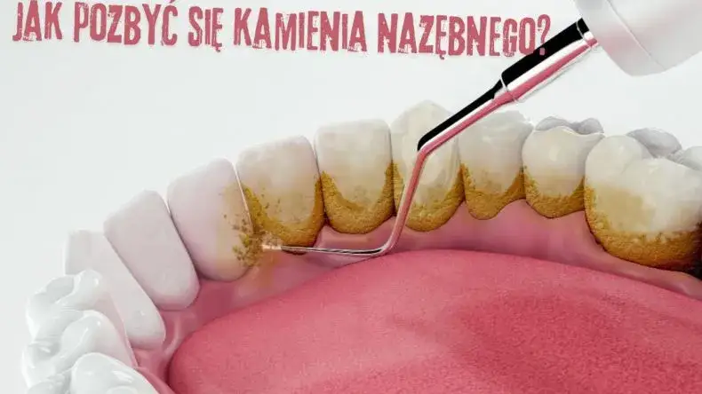 Jak usunąć kamień nazębny bez dentysty - skuteczne metody i pułapki