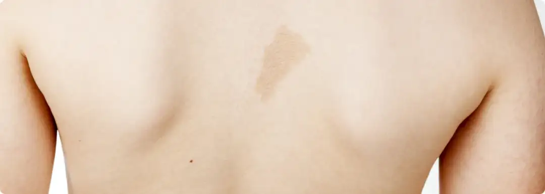 Milchkaffee Fleck: Ursachen, Behandlung und wichtige Informationen