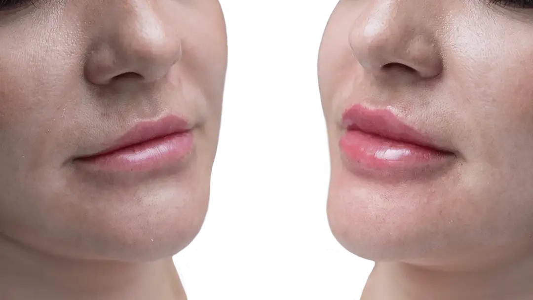 Powiększanie ust a całowanie: Kiedy bezpiecznie wrócić do intymności?