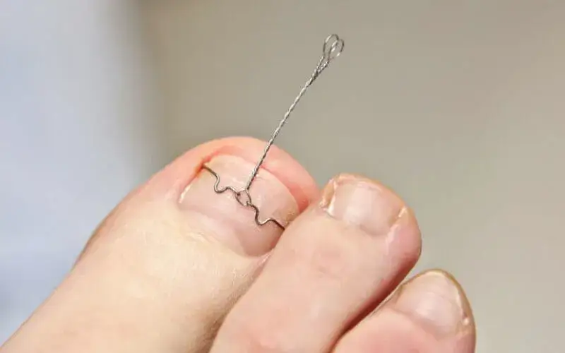 Jak zdjąć klamrę z paznokcia bez ryzyka uszkodzenia i bólu
