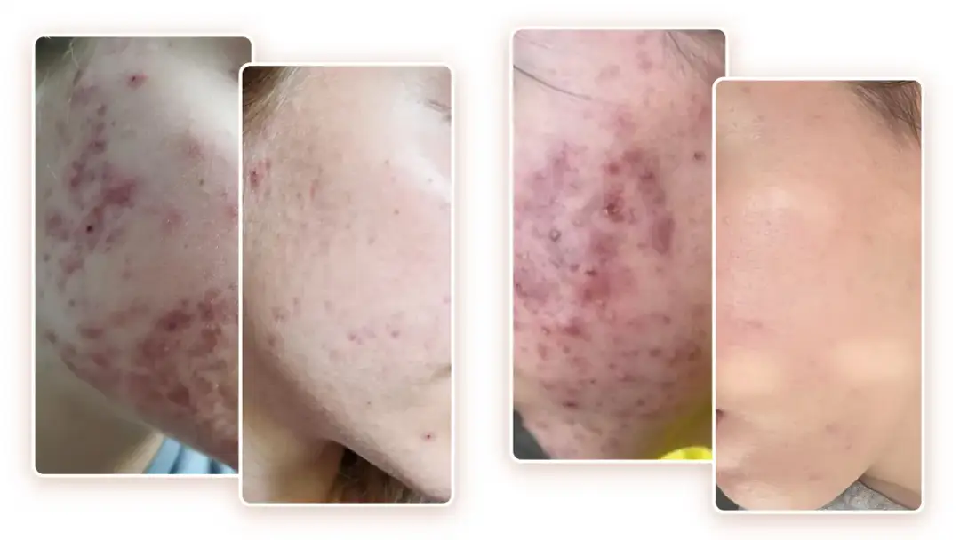 Jak zapobiec trądzikowi? Skuteczna profilaktyka krok po kroku