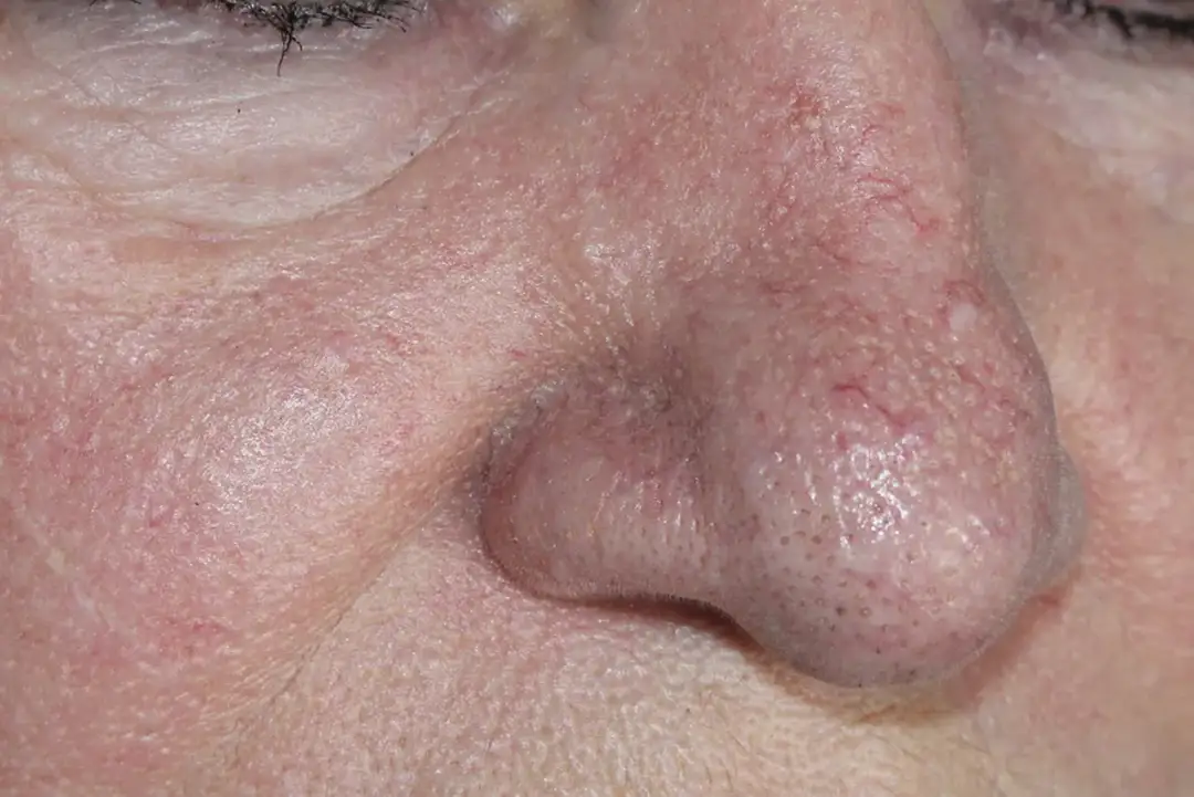 Jak dbać o cerę naczynkową? Skuteczne metody i porady dla zdrowej skóry