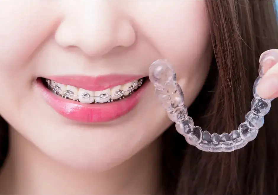Ile nosi się aparat na zęby stały? Odkryj, co wpływa na czas leczenia