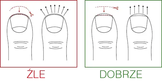 Czym obcinać paznokcie, aby uniknąć wrastania i bólu?