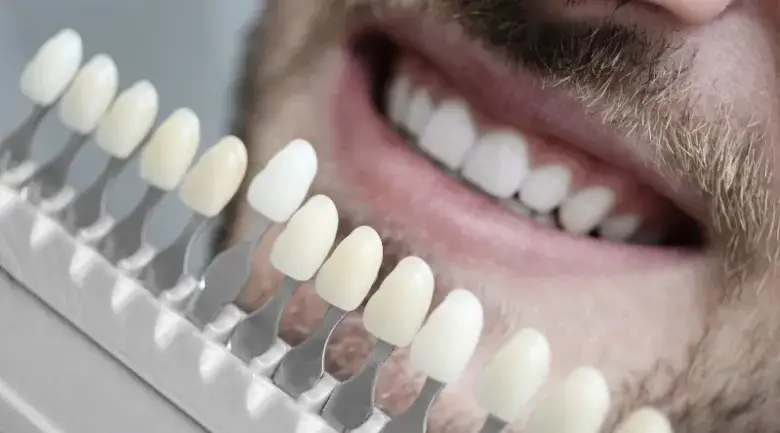 Licówki na zęby co to jest i jak mogą odmienić Twój uśmiech