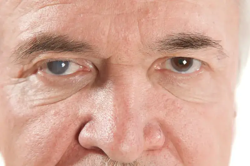 Objawy jaskry wtórnej: jak je rozpoznać i uniknąć poważnych problemów